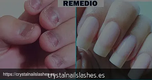 como crecer las uñas mordidas antes