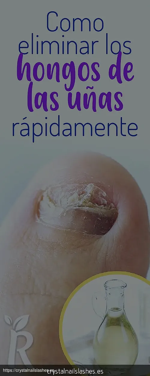 como curar hongos de las uñas con bicarbonato