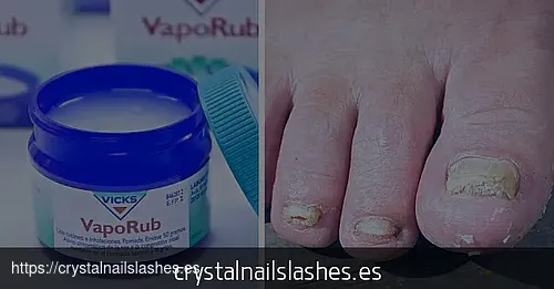 como curar hongos de las uñas con bicarbonato