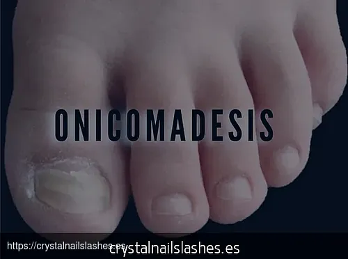 porque me como las uñas
