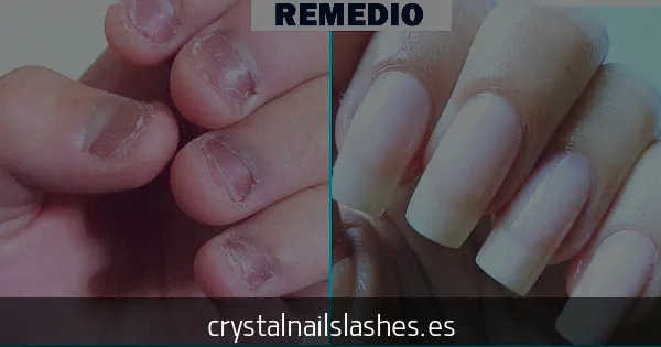 como crecer las uñas mordidas antes