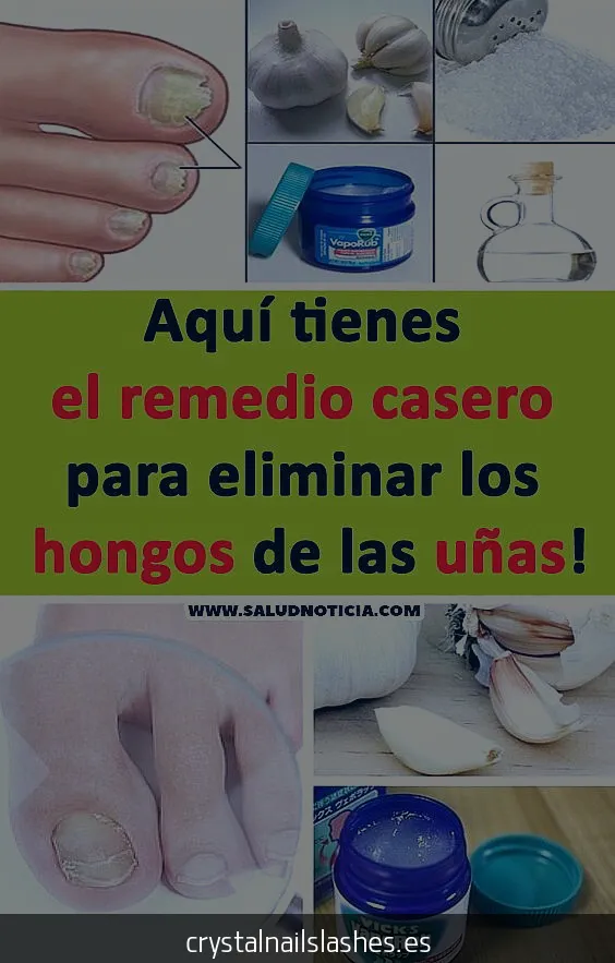 como curar hongos uñas manos