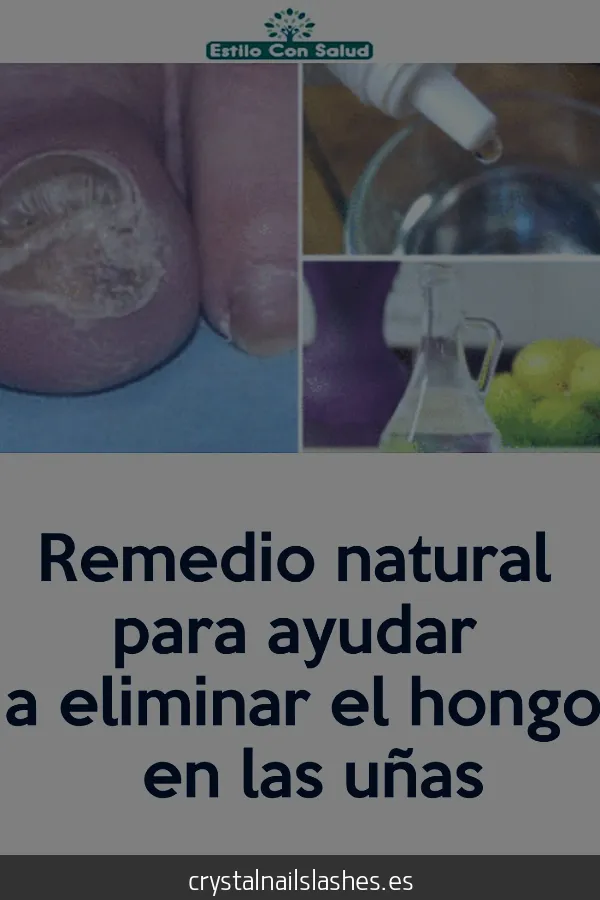 cómo quitar los hongos de las uñas delas manos