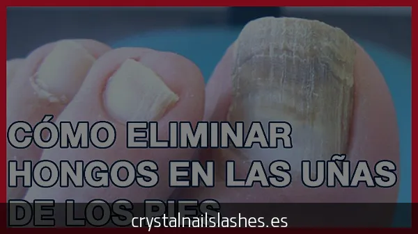 cómo quitar los hongos de las uñas delas manos