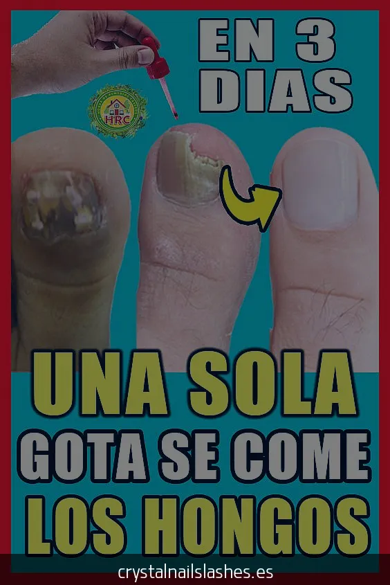 como quitar los hongos de las uñas del pie